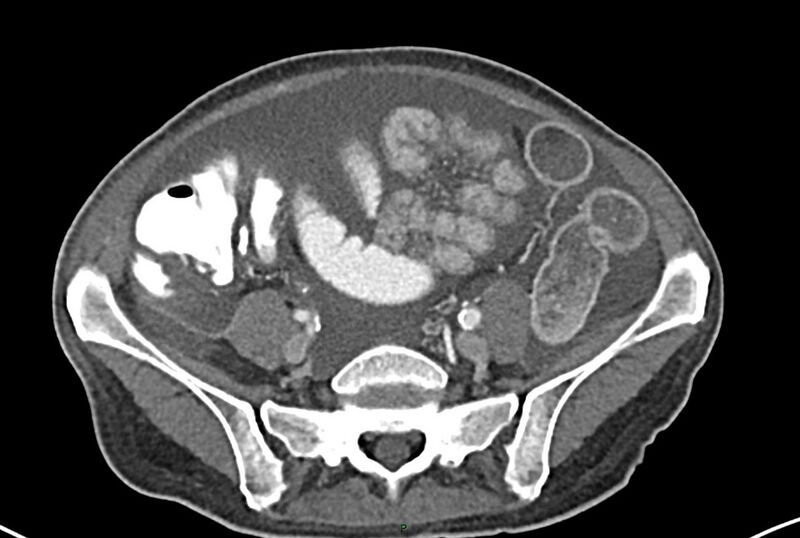 File:Carcinoid mesenteric tumor complicated by chylous ascites (Radiopaedia 76312-87953 A 53).jpg