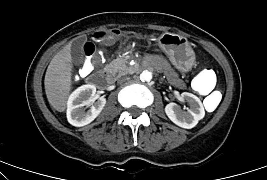 Carcinoid mesenteric tumor complicated by chylous ascites (Radiopaedia 76312-88926 A 30).jpg
