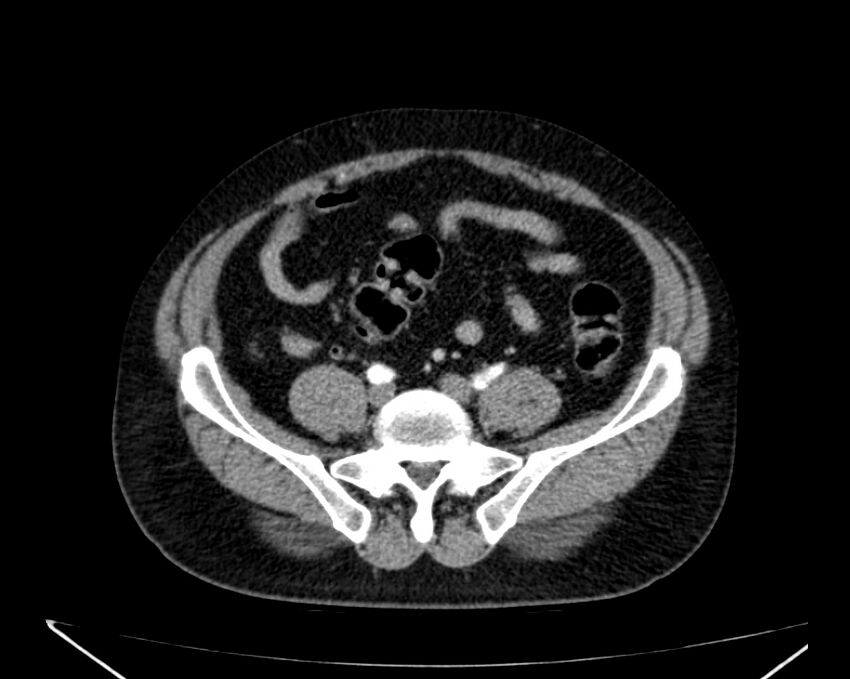 Carcinoid tumor with hepatic metastases (Radiopaedia 22651-22670 B 63).jpg