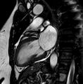 Cardiac sarcoidosis (Radiopaedia 74548-85535 2ch Cine SSFP 8).jpg