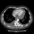 Cardiac tamponade (Radiopaedia 78607-91368 Axial C+ CTPA 63).jpg