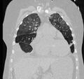 Cardiogenic pulmonary edema (Radiopaedia 29213-29609 Coronal lung window 23).jpg