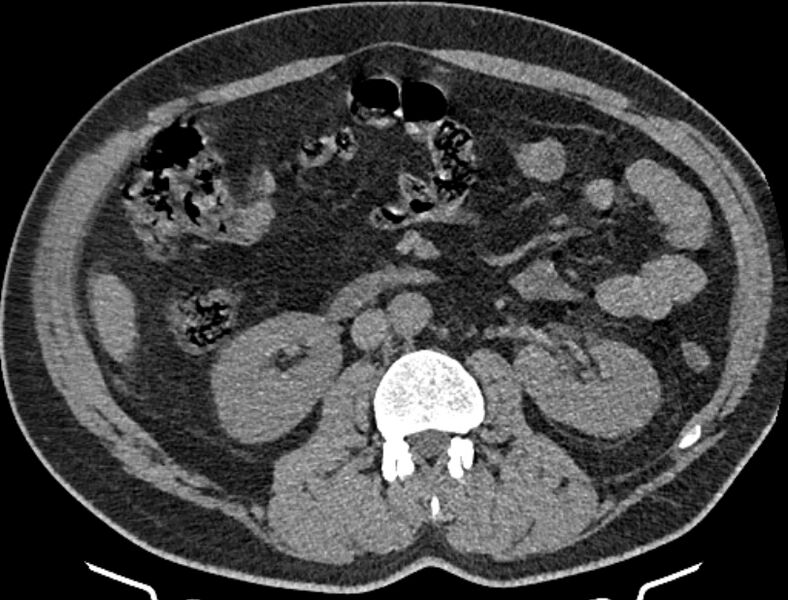 File:Cardiogenic pulmonary edema (Radiopaedia 68180-77678 Axial non-contrast 85).jpg