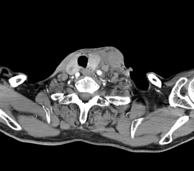 File:Carotid artery pseudoaneurysm (Radiopaedia 84030-99259 C 65).jpg