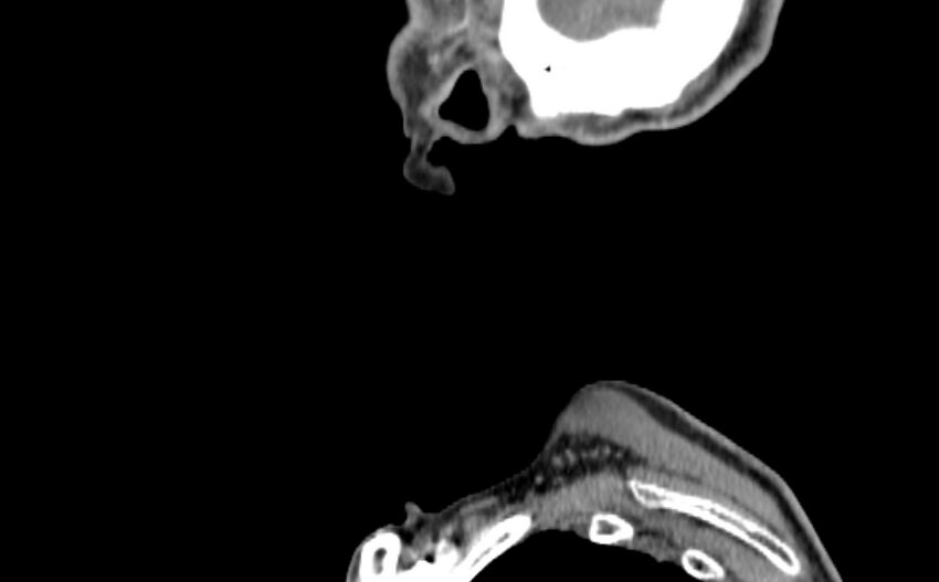 Carotid artery pseudoaneurysm (Radiopaedia 84030-99259 E 70).jpg