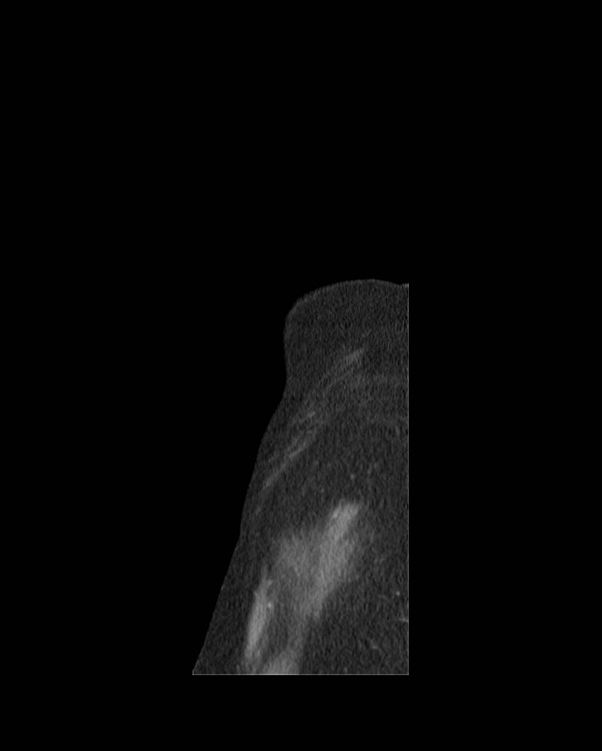 Cecal volvulus (Radiopaedia 54998-61310 C 5).jpg