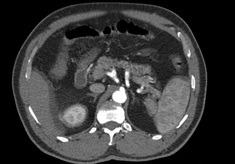 File:Celiac artery dissection (Radiopaedia 52194-58080 A 29).jpg