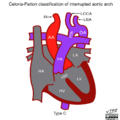 Celoria-Patton classification of interrupted aortic arch (illustration) (Radiopaedia 51881-57708 D 1).png