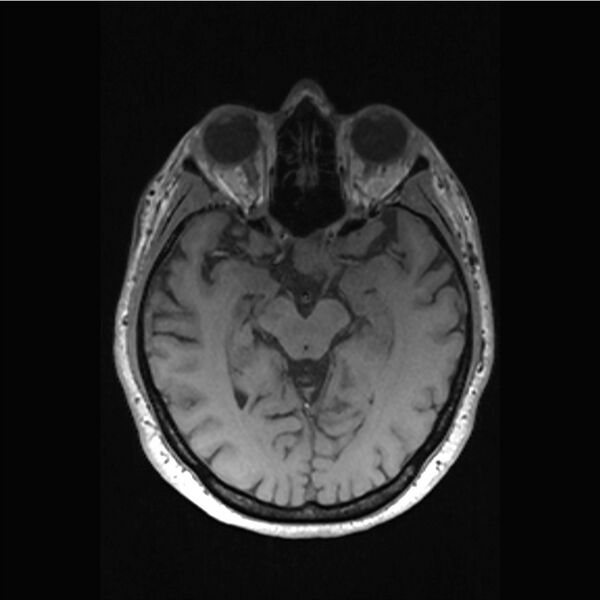 File:Central base of skull meningioma (Radiopaedia 53531-59549 Axial T1 24).jpg