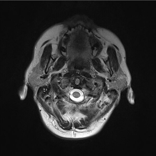 File:Central base of skull meningioma (Radiopaedia 53531-59549 Axial T2 1).jpg