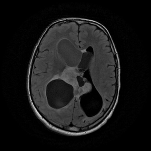 File:Central neurocytoma (Radiopaedia 67618-77021 Axial FLAIR 15).jpg