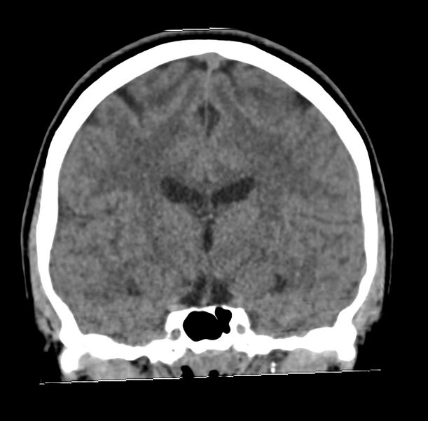 File:Cerebellar agenesis (Radiopaedia 30203-30817 Coronal non-contrast 20).jpg