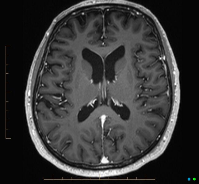 File:Cerebellar gangliocytoma (Radiopaedia 65377-74422 Axial T1 C+ 76).jpg