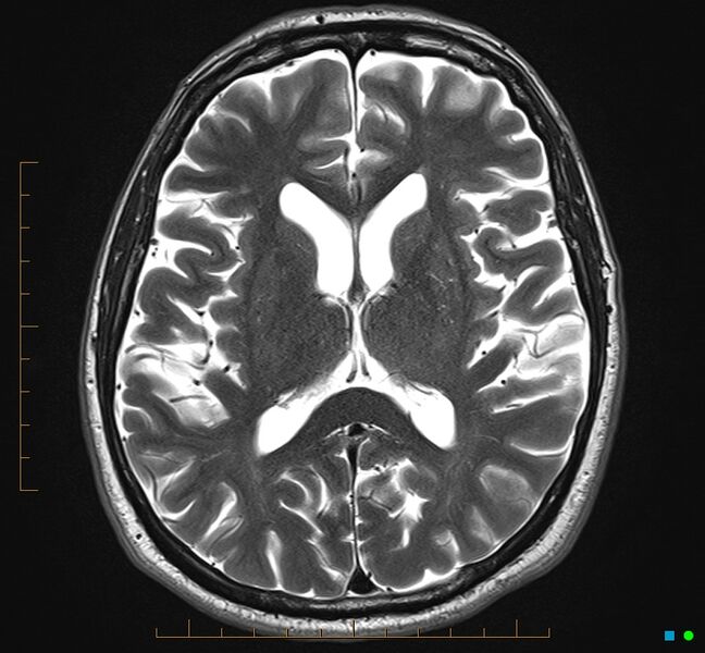 File:Cerebellar gangliocytoma (Radiopaedia 65377-74422 Axial T2 21).jpg