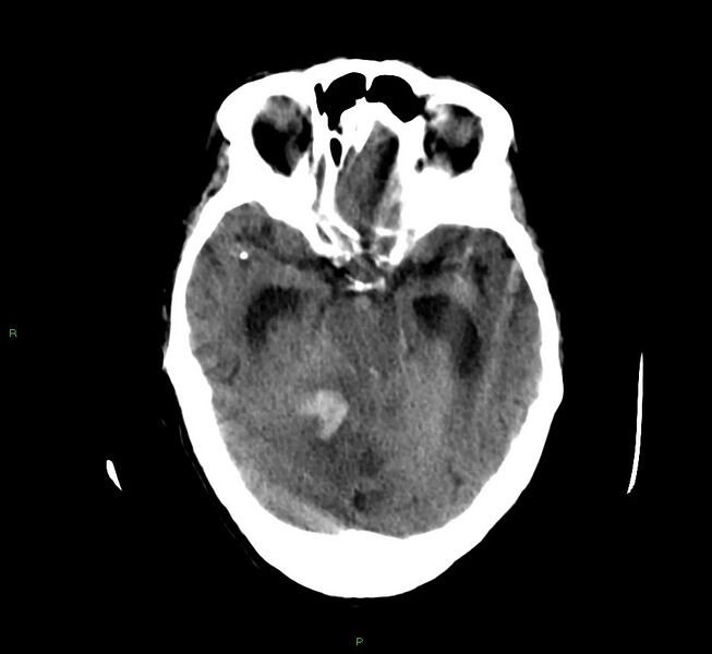 File:Cerebellar hemorrhage (Radiopaedia 58792-66026 Axial non-contrast 33).jpg