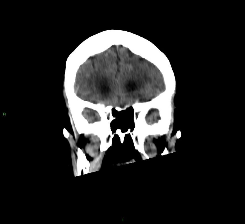 Cerebellar hemorrhage (Radiopaedia 58792-66026 Coronal non-contrast 46).jpg