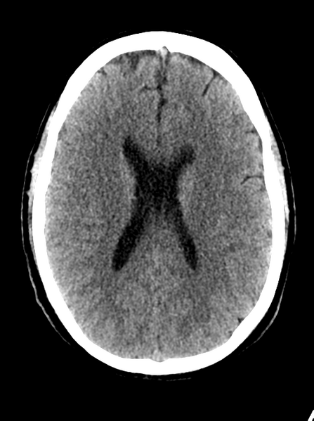 File:Cerebellar infarct due to vertebral artery dissection with posterior fossa decompression (Radiopaedia 82779-97032 Axial non-contrast 18).png