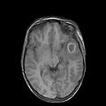 Cerebral abscess post cardiac surgery (Radiopaedia 27244-27420 Axial T1 11).jpg