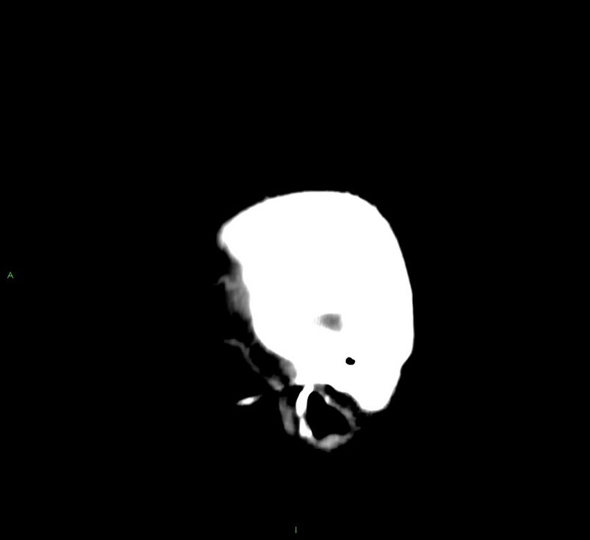 Cerebral amyloid angiopathy-associated lobar intracerebral hemorrhage (Radiopaedia 58376-65513 C 15).jpg