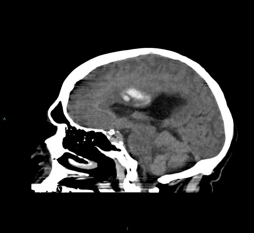 Cerebral amyloid angiopathy-associated lobar intracerebral hemorrhage (Radiopaedia 58560-65723 C 29).jpg