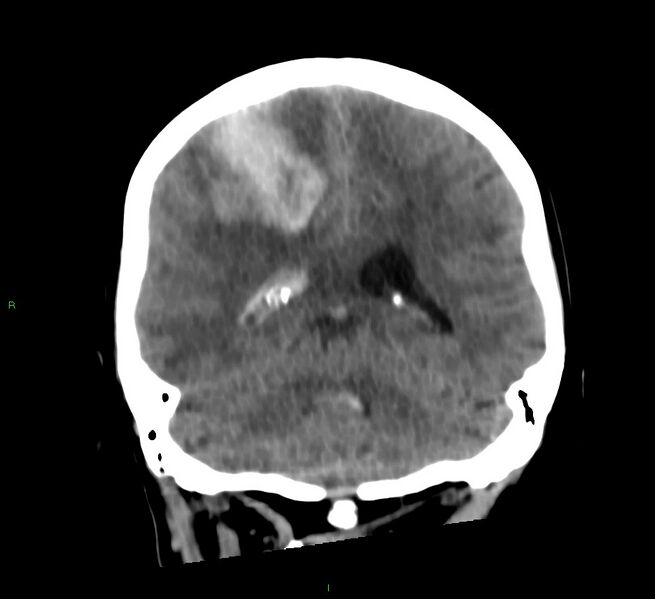 File:Cerebral amyloid angiopathy-associated lobar intracerebral hemorrhage (Radiopaedia 58566-65730 Coronal non-contrast 28).jpg