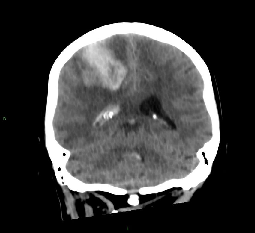 Cerebral amyloid angiopathy-associated lobar intracerebral hemorrhage (Radiopaedia 58566-65730 Coronal non-contrast 28).jpg