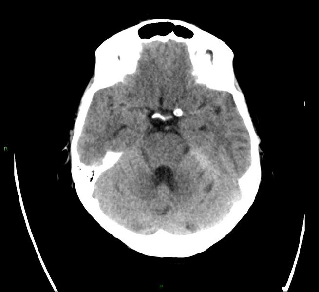 File:Cerebral amyloid angiopathy-associated lobar intracerebral hemorrhage (Radiopaedia 58566-65731 Axial non-contrast 8).jpg