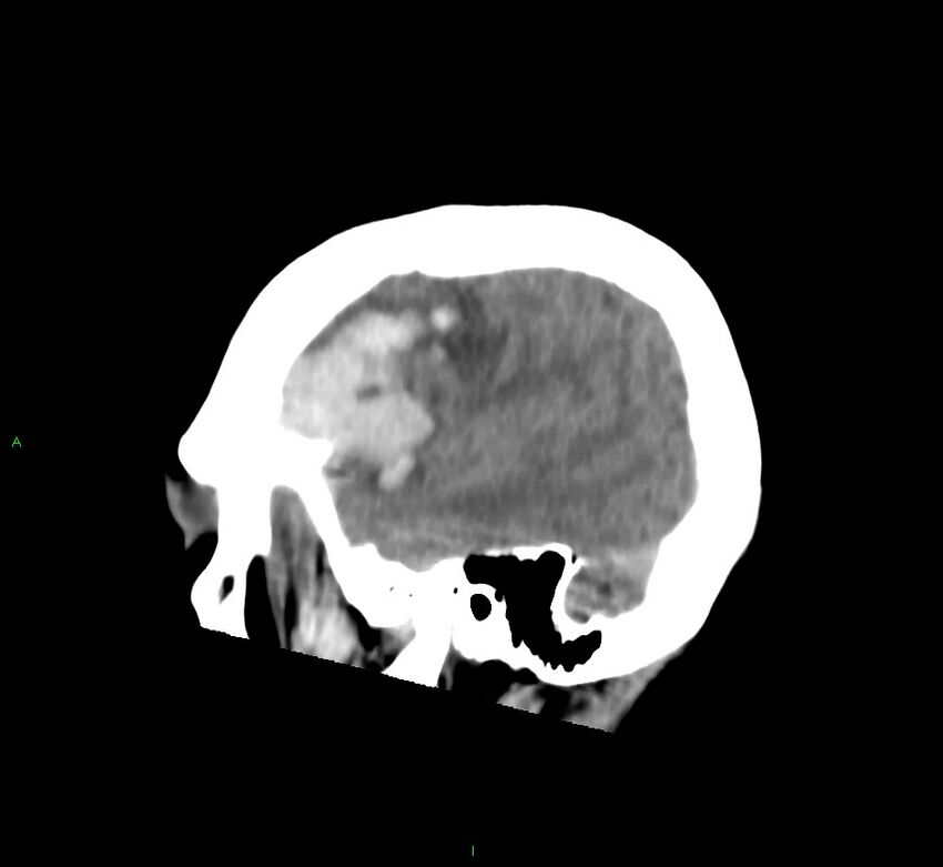 Cerebral amyloid angiopathy-associated lobar intracerebral hemorrhage (Radiopaedia 58752-65973 C 43).jpg