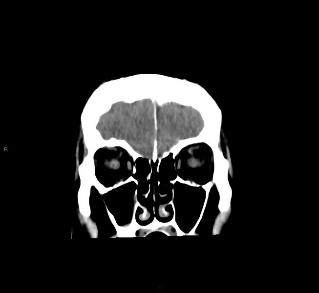 File:Cerebral amyloid angiopathy-associated lobar intracerebral hemorrhage (Radiopaedia 58756-65977 Coronal non-contrast 54).jpg