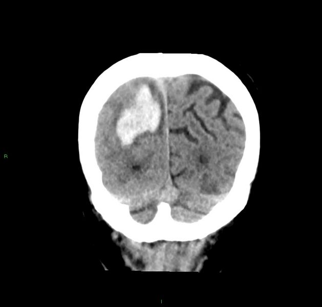 File:Cerebral amyloid angiopathy-associated lobar intracerebral hemorrhage (Radiopaedia 59356-66716 Coronal non-contrast 13).jpg