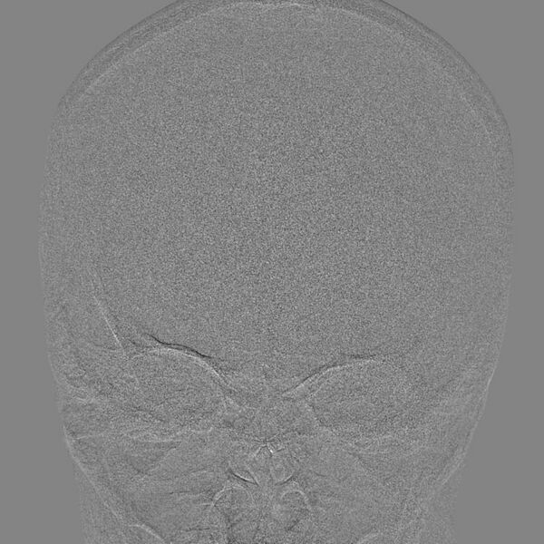 File:Cerebral aneurysm with rupture (Radiopaedia 29933-30458 LT CCA IC 11).jpg