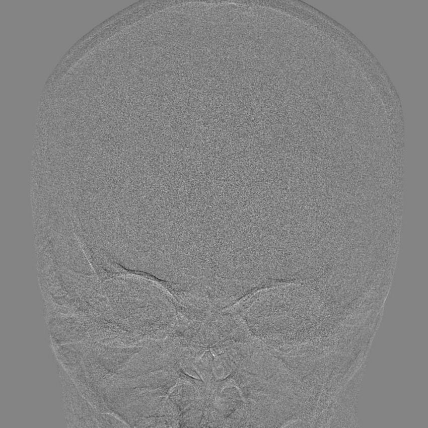 Cerebral aneurysm with rupture (Radiopaedia 29933-30458 LT CCA IC 11).jpg