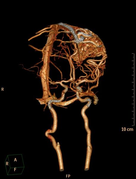 File:Cerebral arteriovenous malformation (Radiopaedia 29531-30031 B 2).jpg