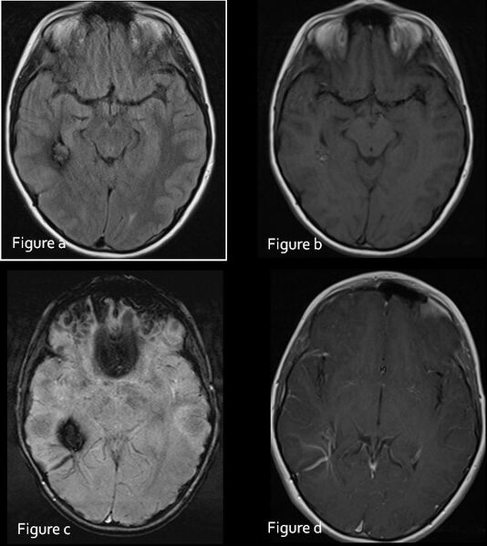 File:Cerebral cavernoma with developmental venous anomaly (Radiopaedia 9218).jpg