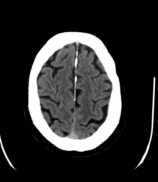 File:Cerebral dural venous sinus thrombosis (Radiopaedia 86514-102575 Axial non-contrast 35).jpg