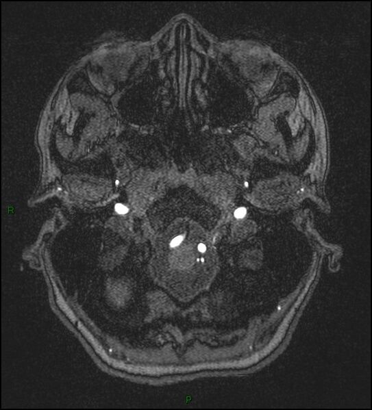 File:Cerebral fat embolism (Radiopaedia 35022-36525 Axial TOF 17).jpg