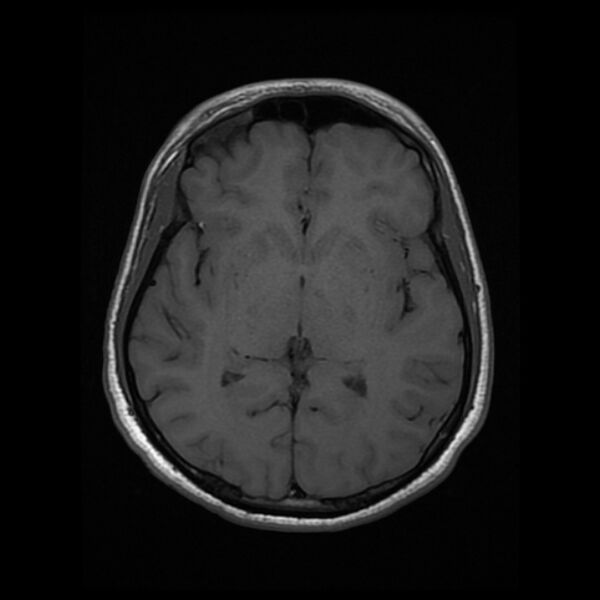 File:Cerebral fat embolism (Radiopaedia 37510-39363 Axial T1 14).jpg
