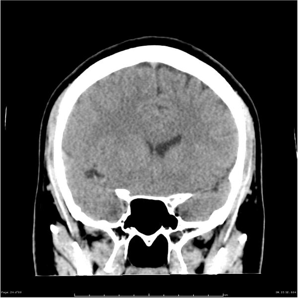 File:Cerebral hemorrhage secondary to arteriovenous malformation (Radiopaedia 33497-34561 Coronal non-contrast 15).jpg