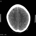 Cerebral hemorrhagic contusion with subdural and subarachnoid hemorrhage (Radiopaedia 10680-19197 Axial non-contrast 18).jpg