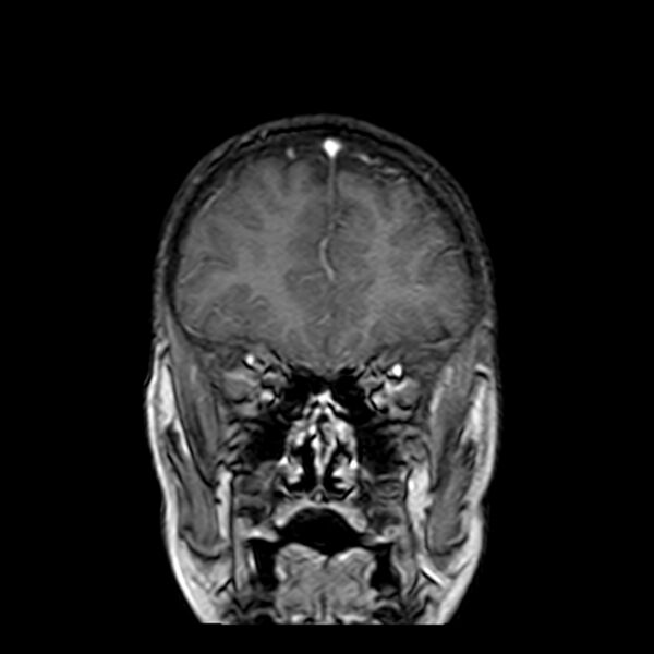 File:Cerebral tuberculoma (Radiopaedia 41152-43932 Coronal T1 C+ 3).jpg