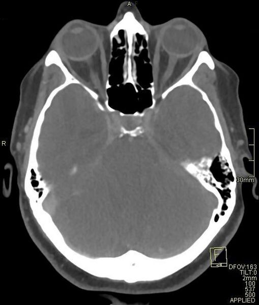 File:Cerebral venous sinus thrombosis (Radiopaedia 91329-108965 Axial venogram 28).jpg