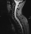 Cervical dural CSF leak on MRI and CT treated by blood patch (Radiopaedia 49748-54995 D 4).png