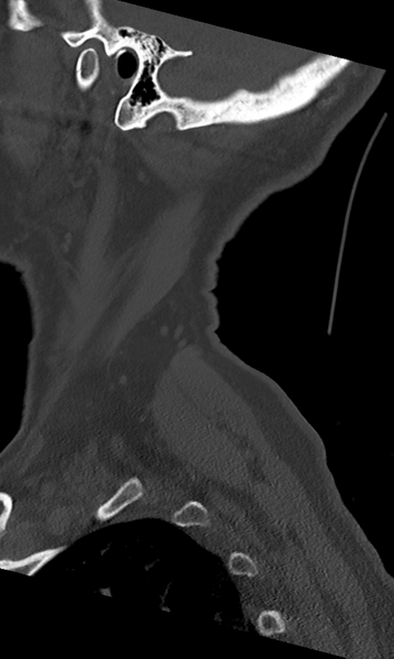 File:Cervical spine fracture - chalk stick (Radiopaedia 39116-41323 Sagittal bone window 4).png