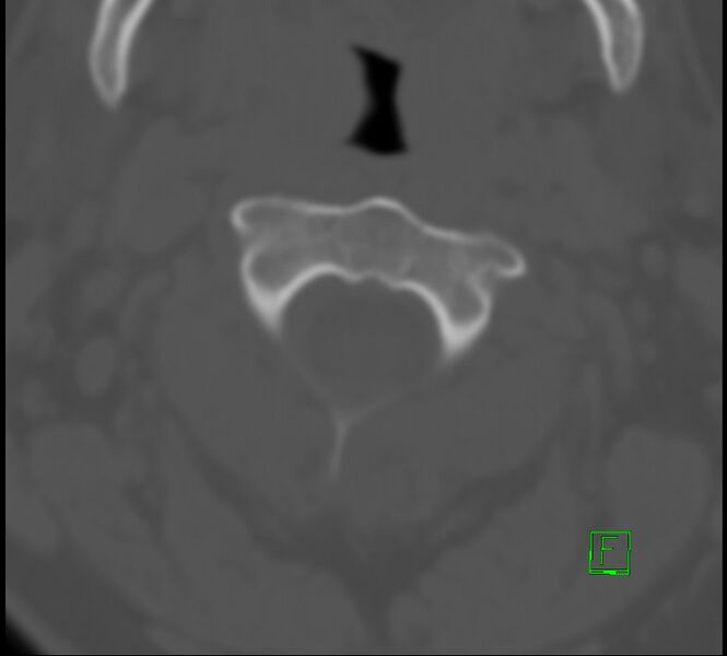 File:Cervical spine fracture - hyperflexion injury (Radiopaedia 66184-75364 Axial bone window 6).jpg