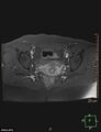Cesarian scar endometriosis (Radiopaedia 68495-78066 Axial T1 C+ fat sat 16).jpg