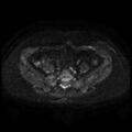 Cesarian section scar endometriosis (Radiopaedia 66520-75799 Axial DWI 28).jpg