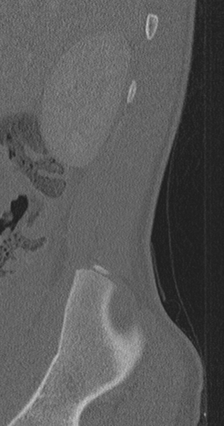 File:Chance fracture (Radiopaedia 40360-42912 Sagittal bone window 94).png