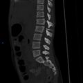 Chance fracture with duodenal and pancreatic lacerations (Radiopaedia 43477-50042 Sagittal bone window 11).jpg
