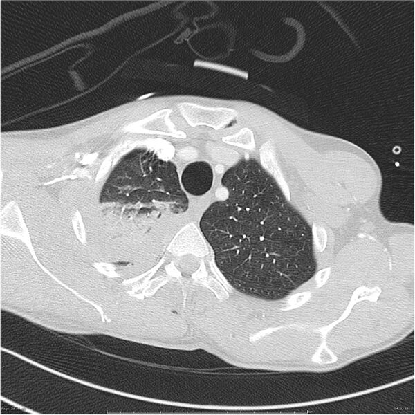 File:Chest and abdomen multi-trauma (Radiopaedia 26294-26425 lung window 25).jpg