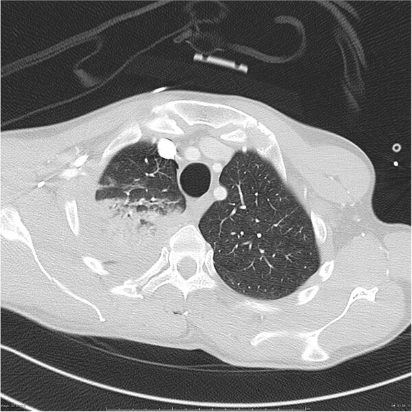 File:Chest and abdomen multi-trauma (Radiopaedia 26294-26425 lung window 27).jpg